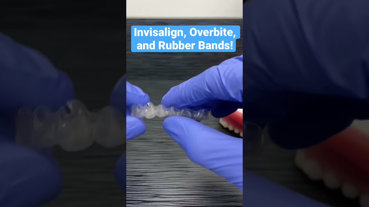 Invisalign, Overbite, and Rubber bands!