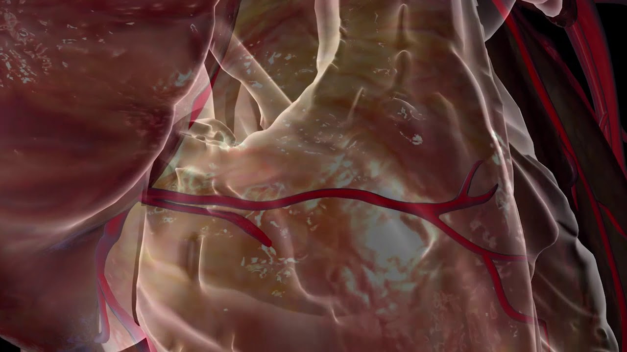 CAIAZ Pacemaker Insertion