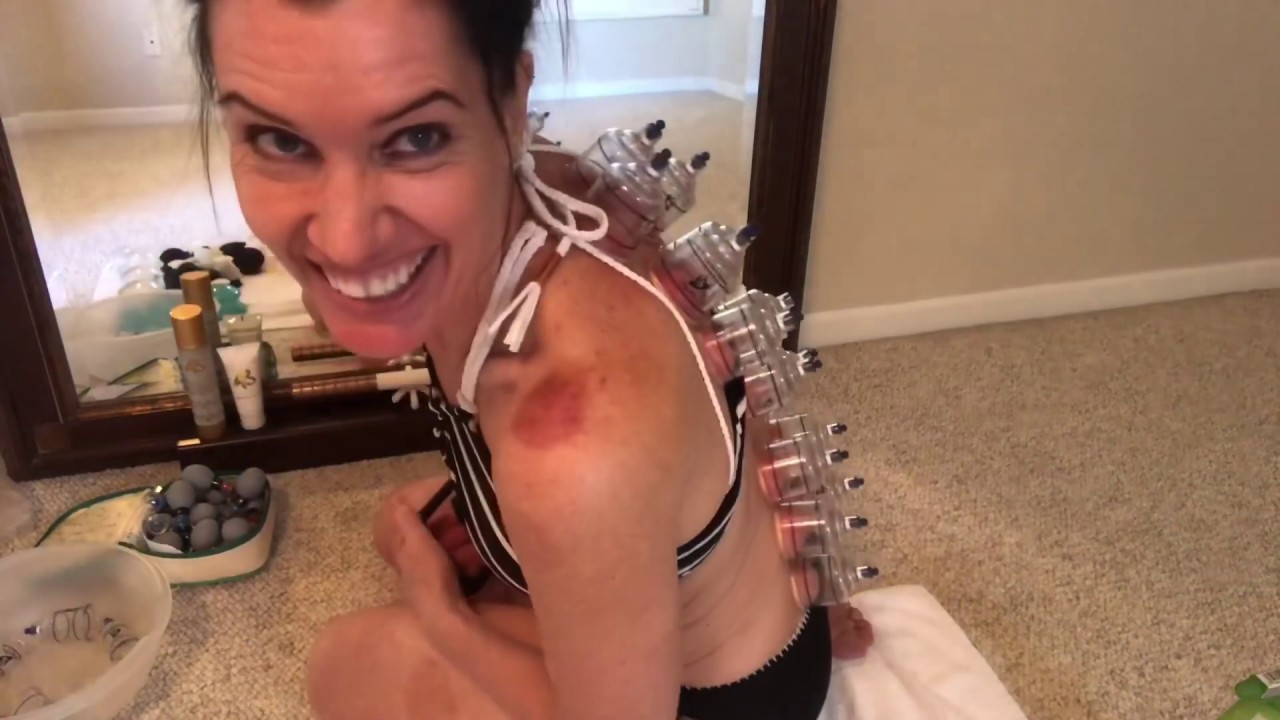 CUPPING: How to cup your own back.