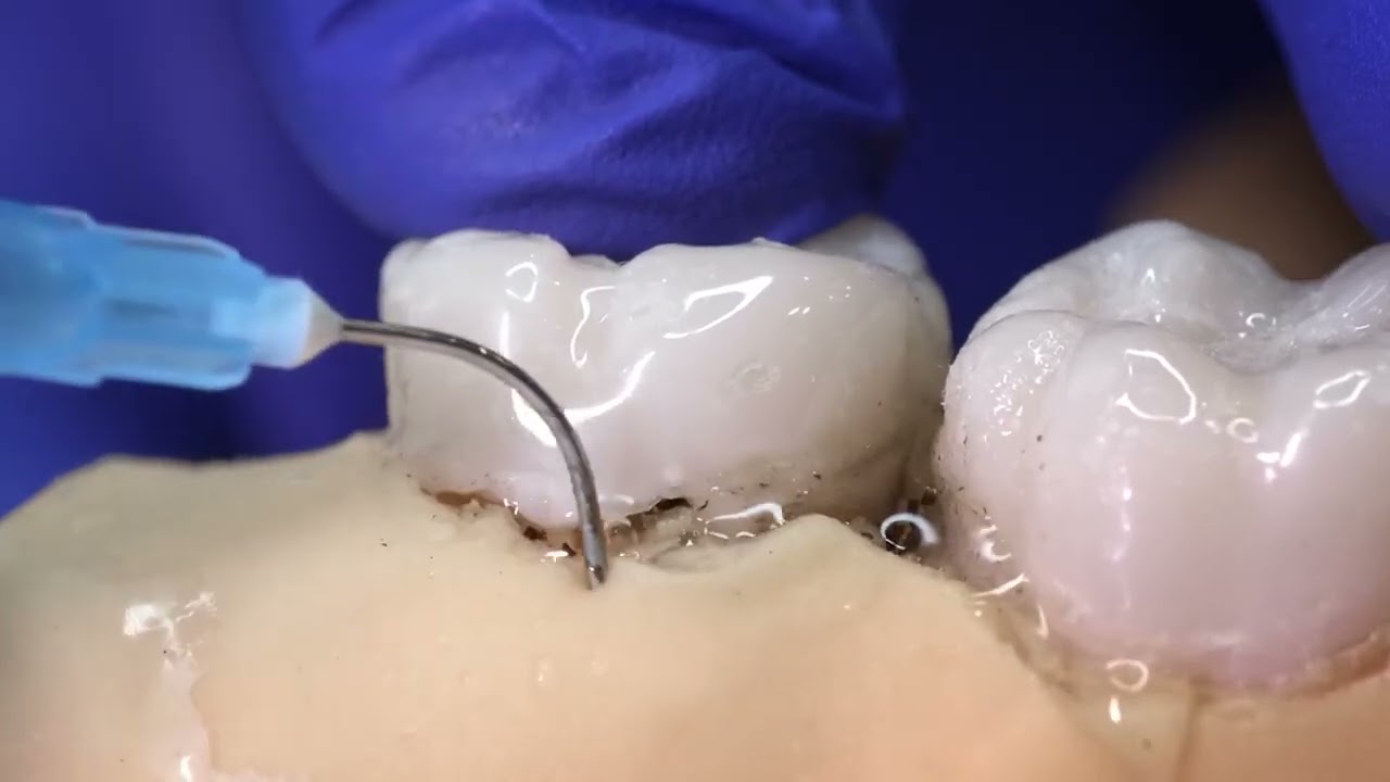How to Use PERIO-FLUSH? Periodontal Pocket Irrigation