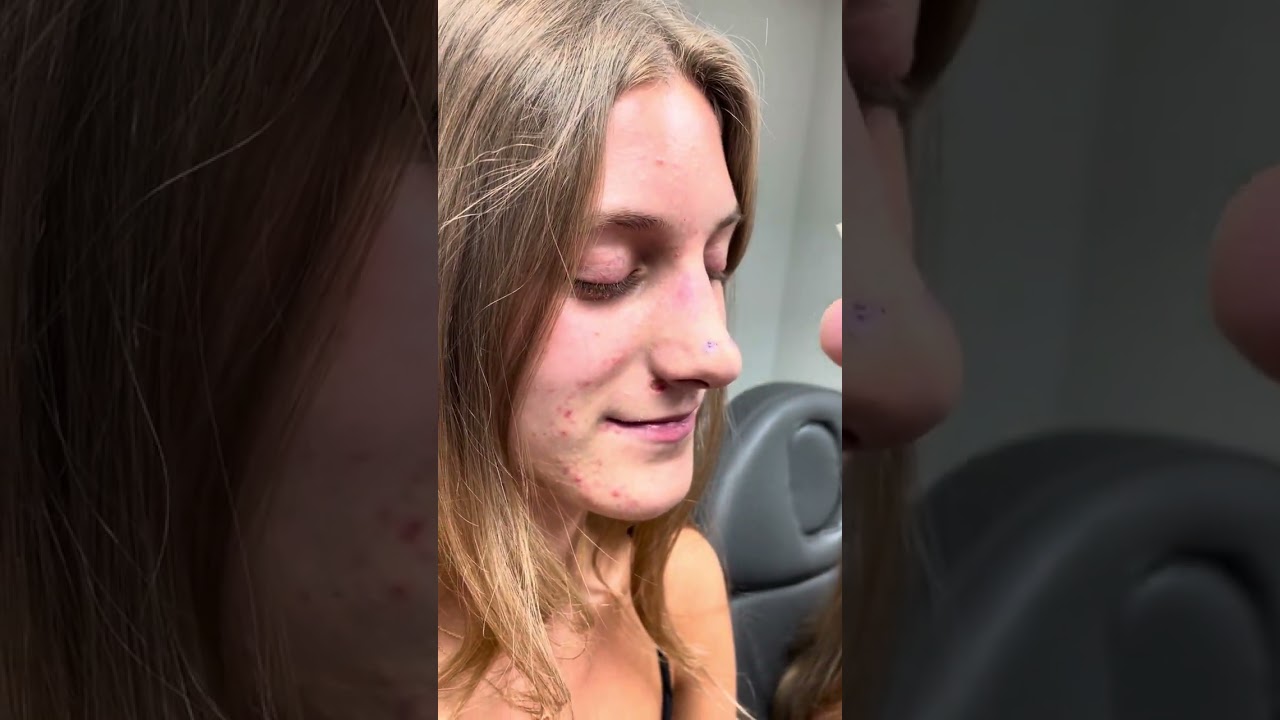 Twins scarless rhinoplasty reveal