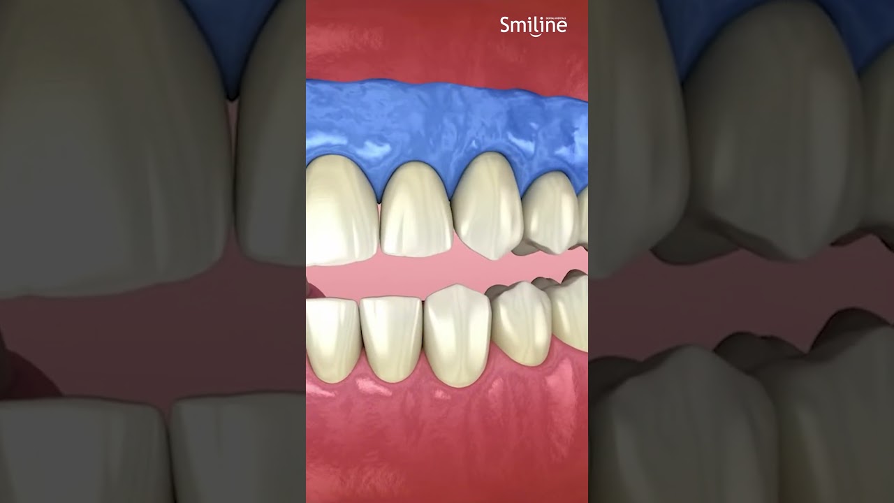 Teeth Whitening | Animated Process Reel | Dental Information | Smiline Dental Hospital | Hyderabad