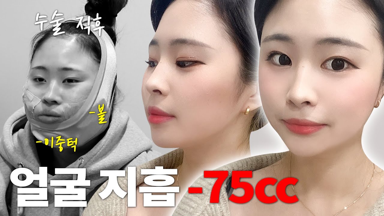 [감자0 Vlog] 얼굴에 있는 지방 다 없애고 왔다❗ 이중턱지방흡입 + 심부볼 제거하고 새 삶을 사는 중😂[쀼]