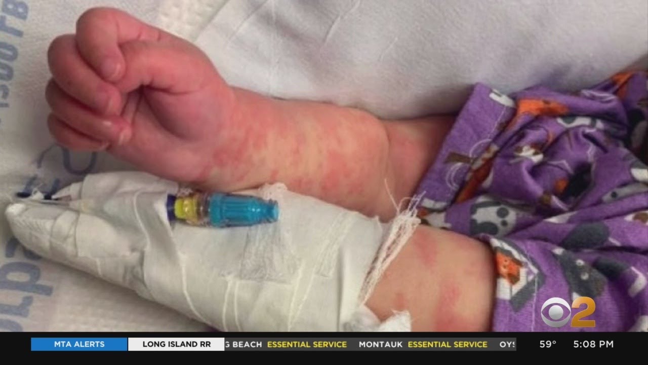 What Are The Symptoms Of Pediatric Multi-System Inflammatory Syndrome?