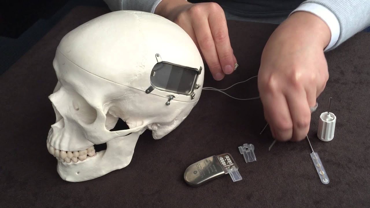 Demonstration of a NeuroPace Responsive Neurostimulation (RNS) device