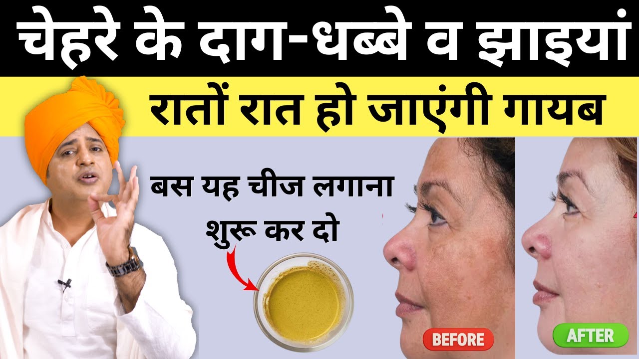रातों रात चेहरे के काले दाग-धब्बे, झाइयां व पिंपल्स के निशान दूर करने का उपाय || Sanyasi Ayurveda ||