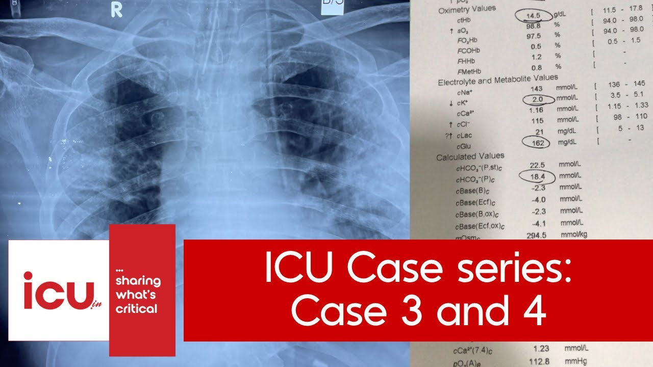 #icucase 3 & 4:  ( misplaced line - where??) & (neuro + metabolic)