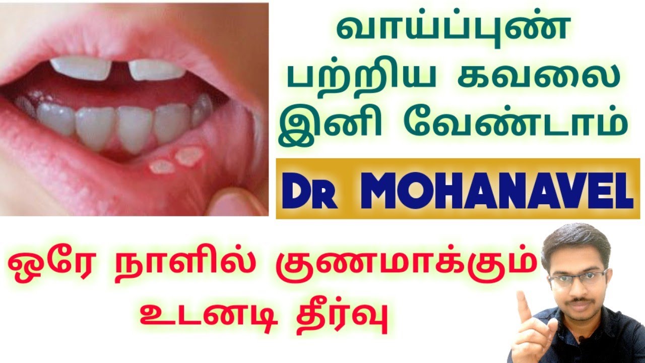 வாய்ப்புண்(Mouth Ulcer) உடனடியாக குணமாக-Home Remedies-Tamil-
Dr MOHANAVEL