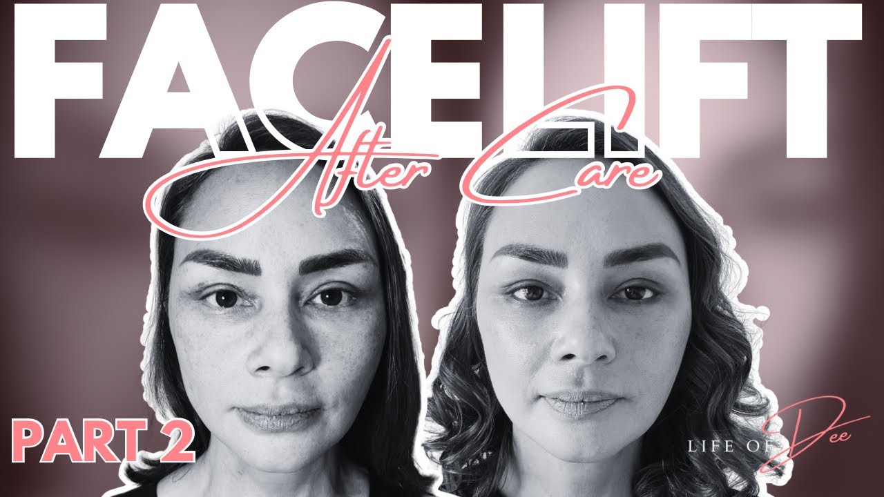 Ang Facelift Journey ni Donita Rose Part 2 | Life Of Dee Ep. 5
