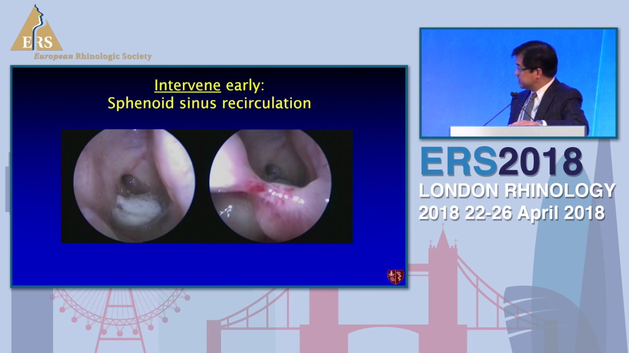 ERS London 2018, P Hwang, Office Based Rhinology