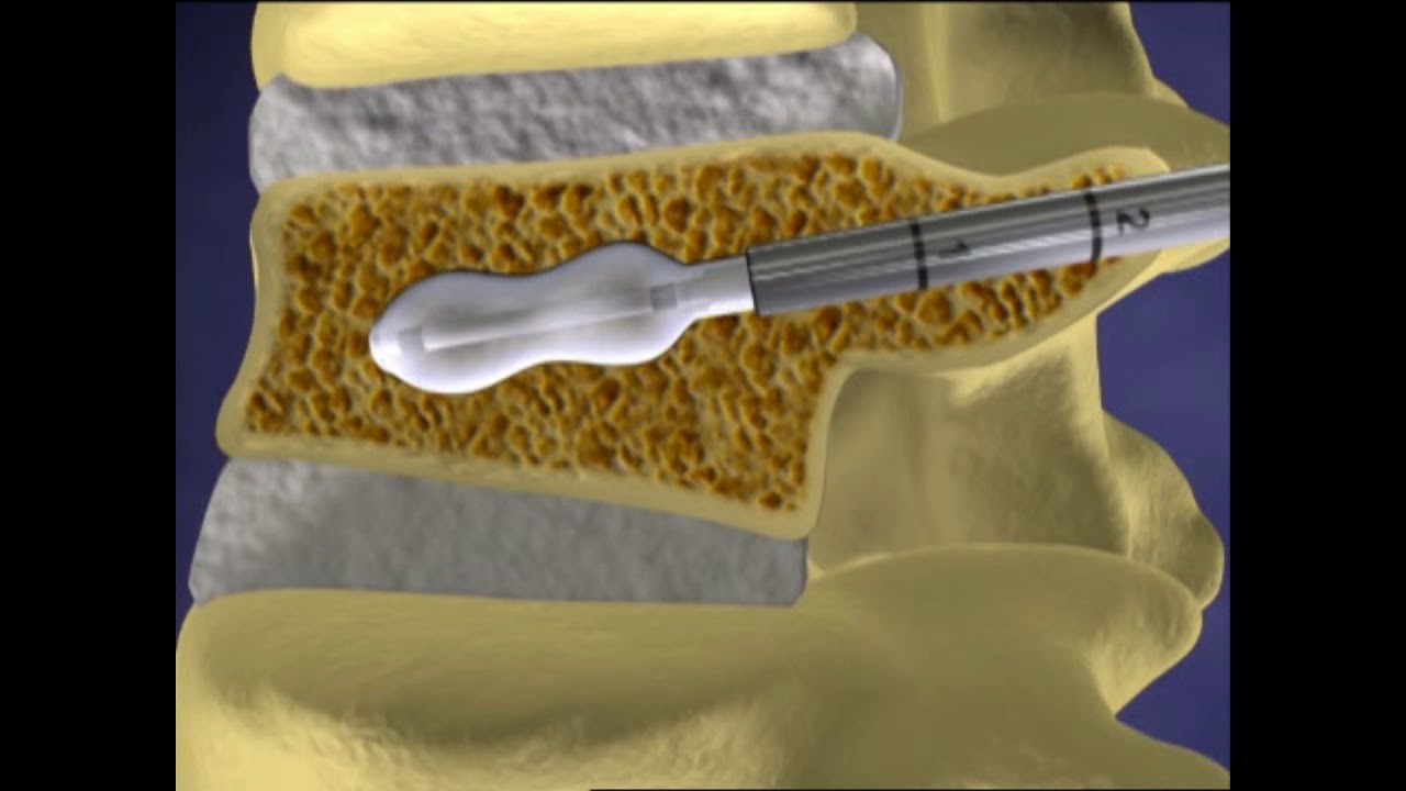 Kyphoplasty (Vertebra Bone Cementing using Balloon)