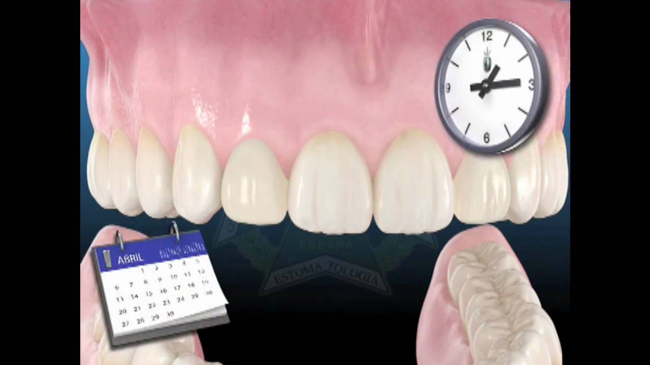 IMPLANTES DENTALES