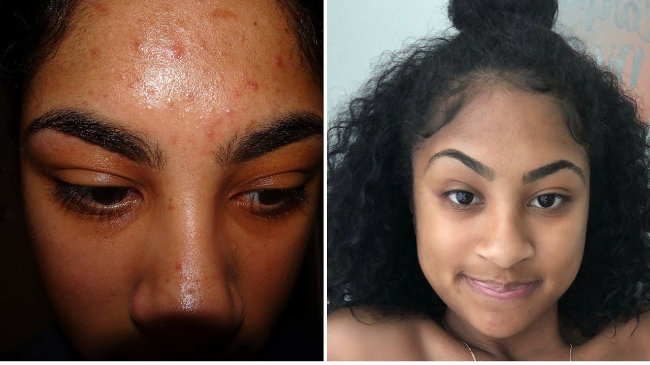 HOW I STOPPED USING FACE WASH TO CLEAR MY SKIN!!