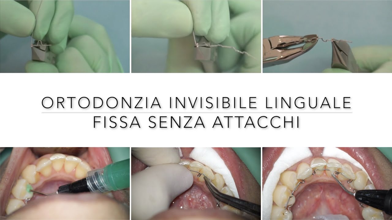 Apparecchio Invisibile: ortodonzia linguale senza attacchi