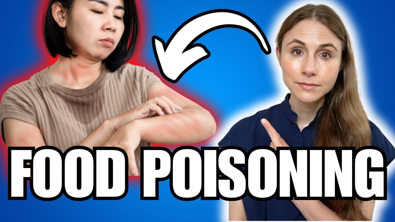 Food Poisoning Symptoms NOT TO MISS: Scrombroid Poisoning