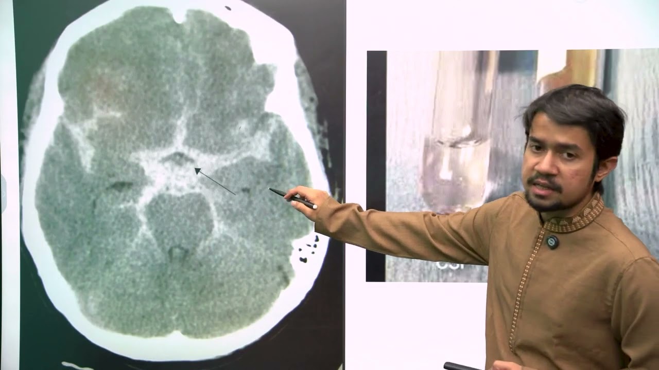 Sub arachnoid Hemorrhage || Davidson Elite Program