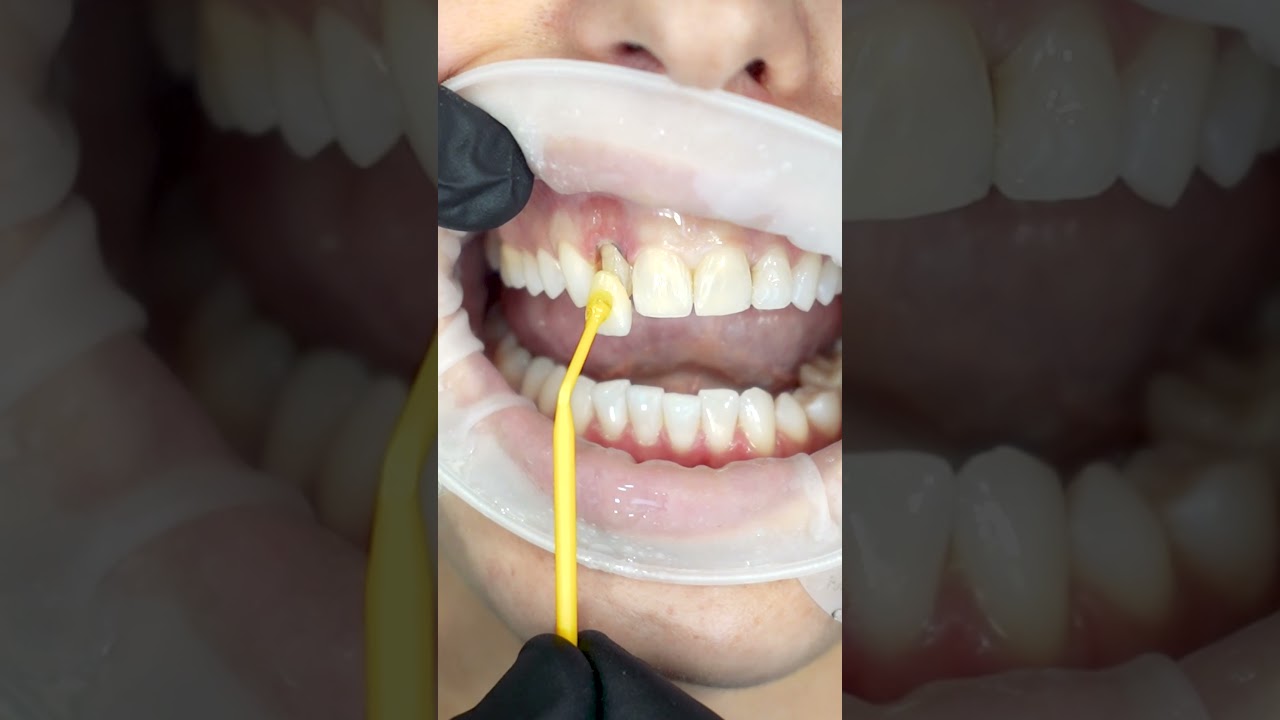 Colocar Facetas Dentárias 