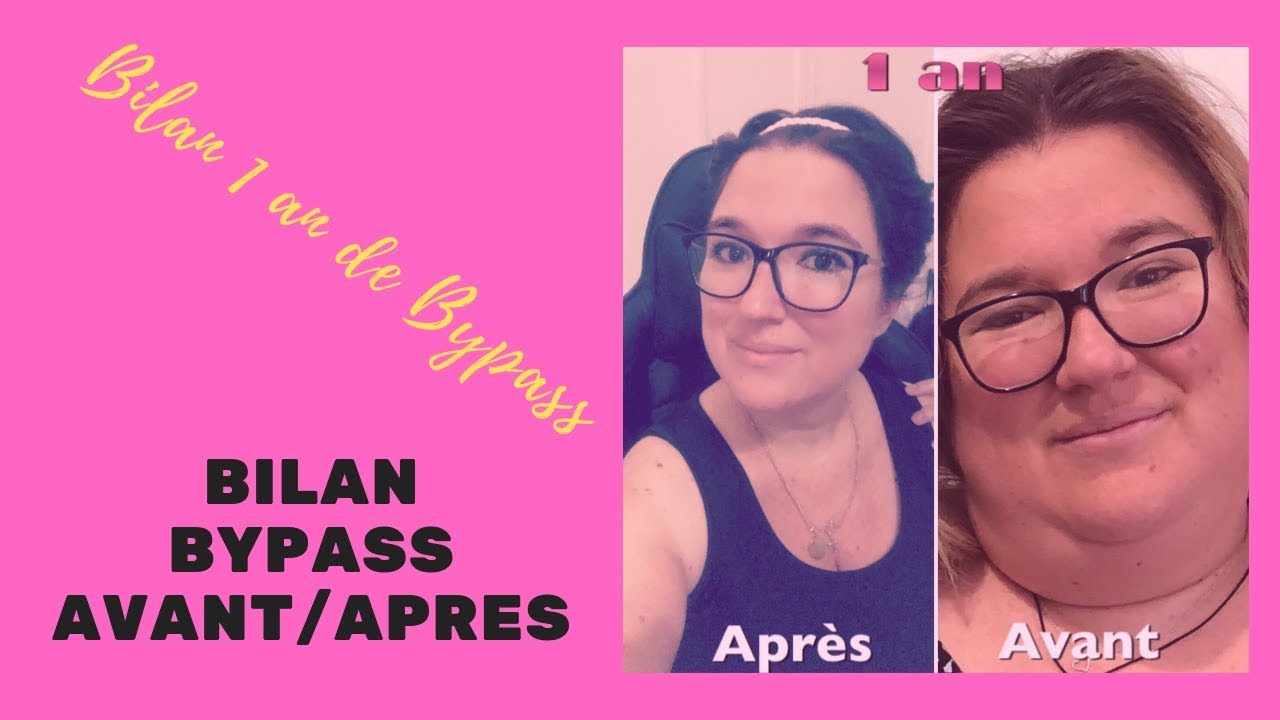 Bilan 1 an de Bypass avant/après