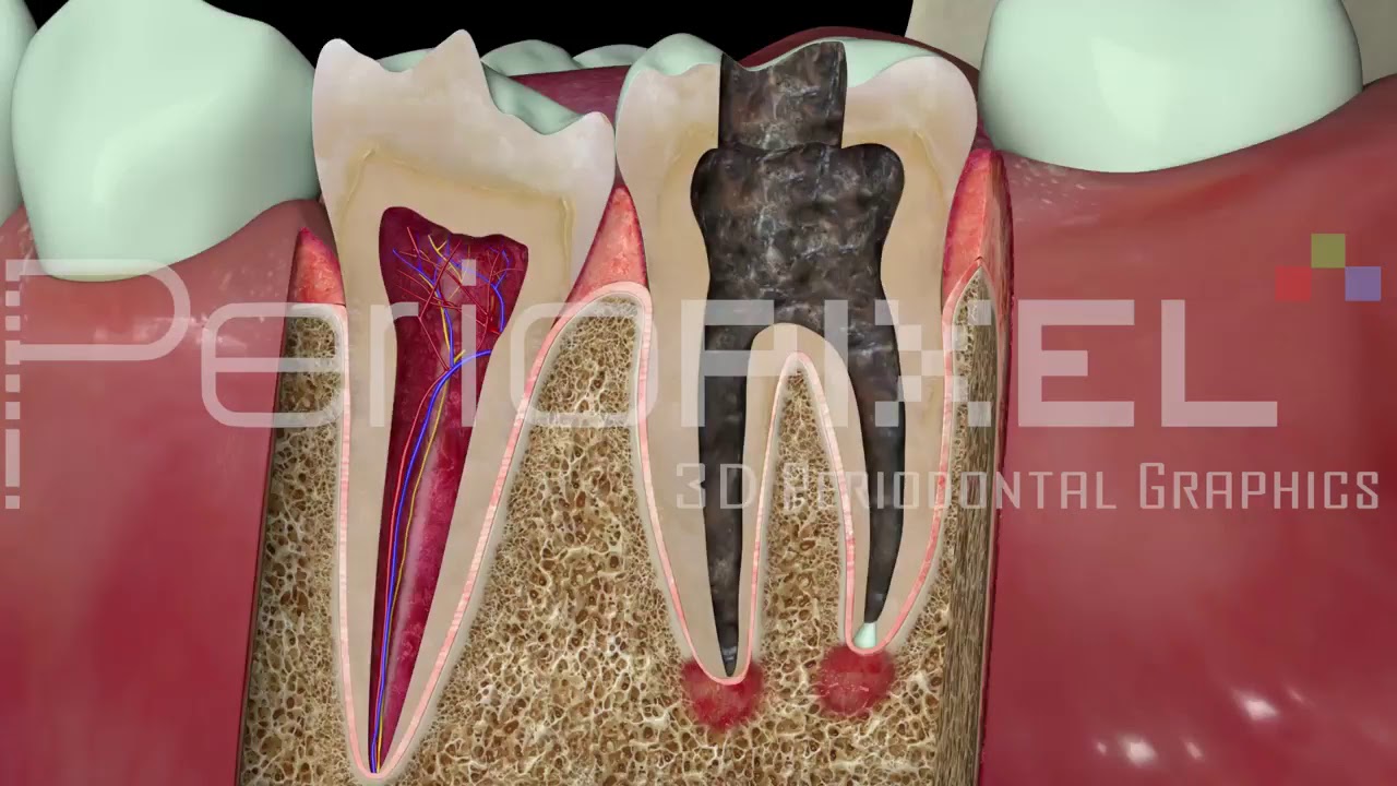 Vídeo 3D Endodoncia en Caries Profunda - PerioPixel