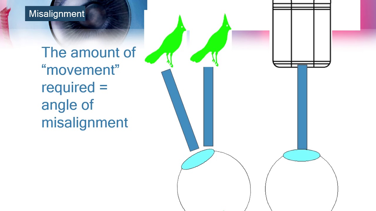 4-1 Special Tests: Hess screen and similar dissociative tests