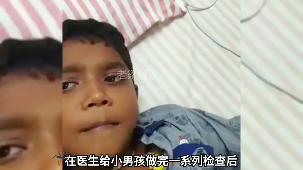 十岁男孩被疯狗咬伤，没能及时打疫苗，导致男孩患上狂犬病#狗咬人事件 #狂犬病 #科普