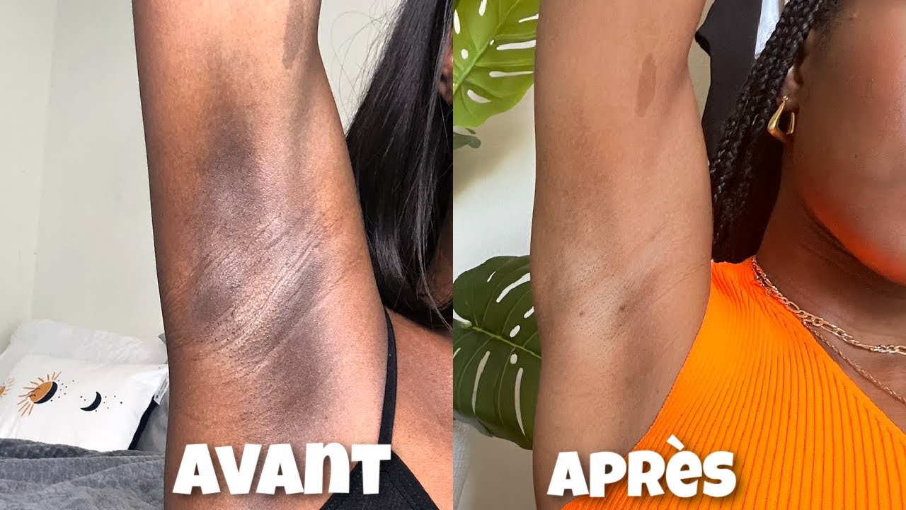 &Eacute;claircir les AISSELLES (sans bicarbonate), les COUDES, le MAILLOT, zones d'HYPERPIGMENTATION
