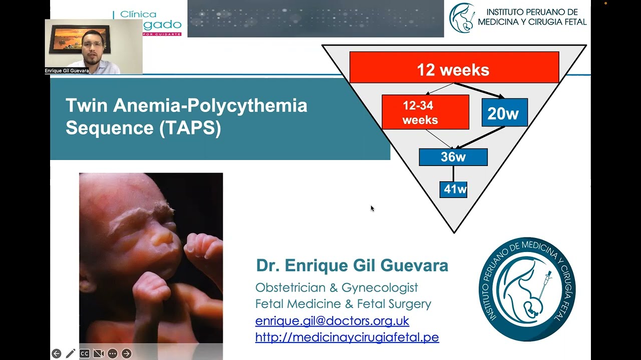 Twin Anemia Polycythemia Sequence