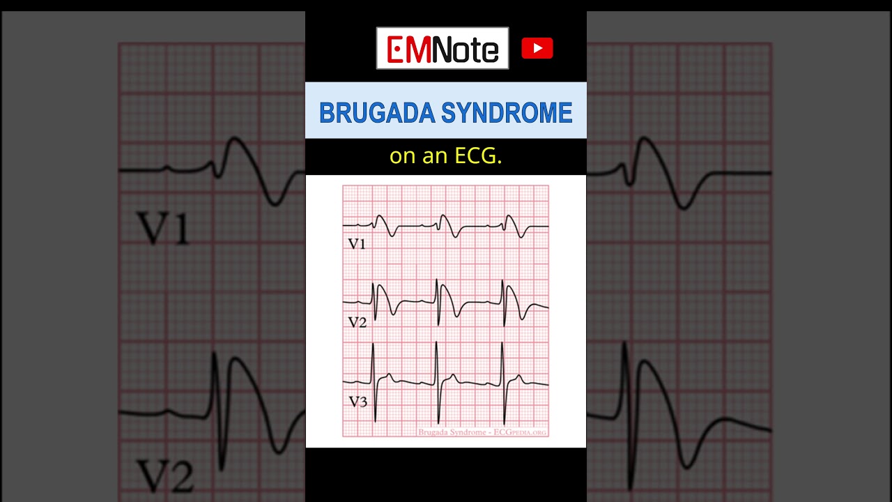 What is Brugada Syndrome?