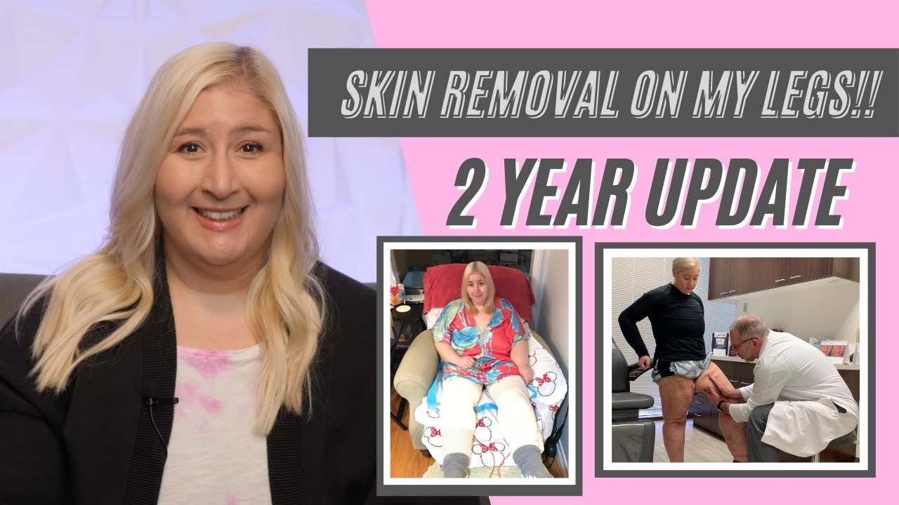 Skin Removal on my Legs After losing 350+ Pounds, 2 Year Update