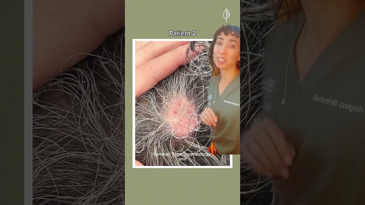 Before and After 1 Treatment for Alopecia Areata  Hair Loss