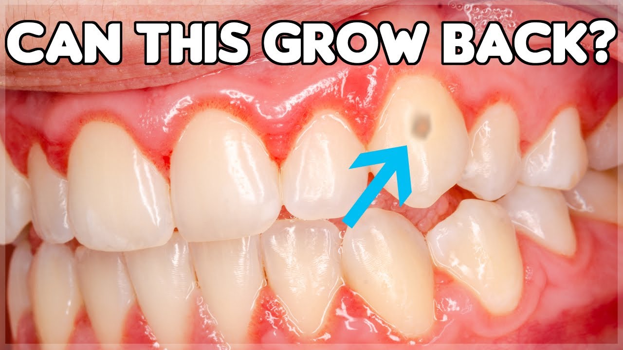 Can Tooth Enamel Grow Back? (How To Prevent Enamel Erosion)