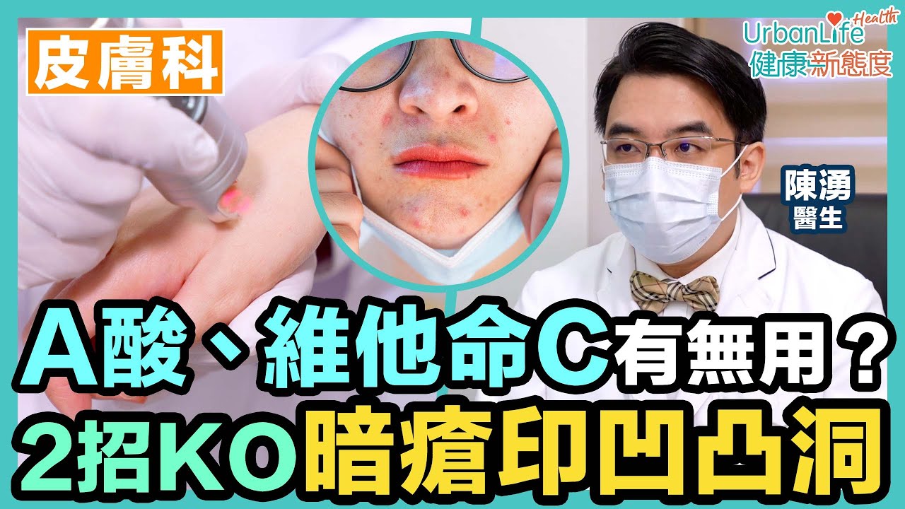 【暗瘡印消除】洗米水、維他命C、A酸有無用？2招KO暗瘡印、凹凸洞＋4個預防貼士