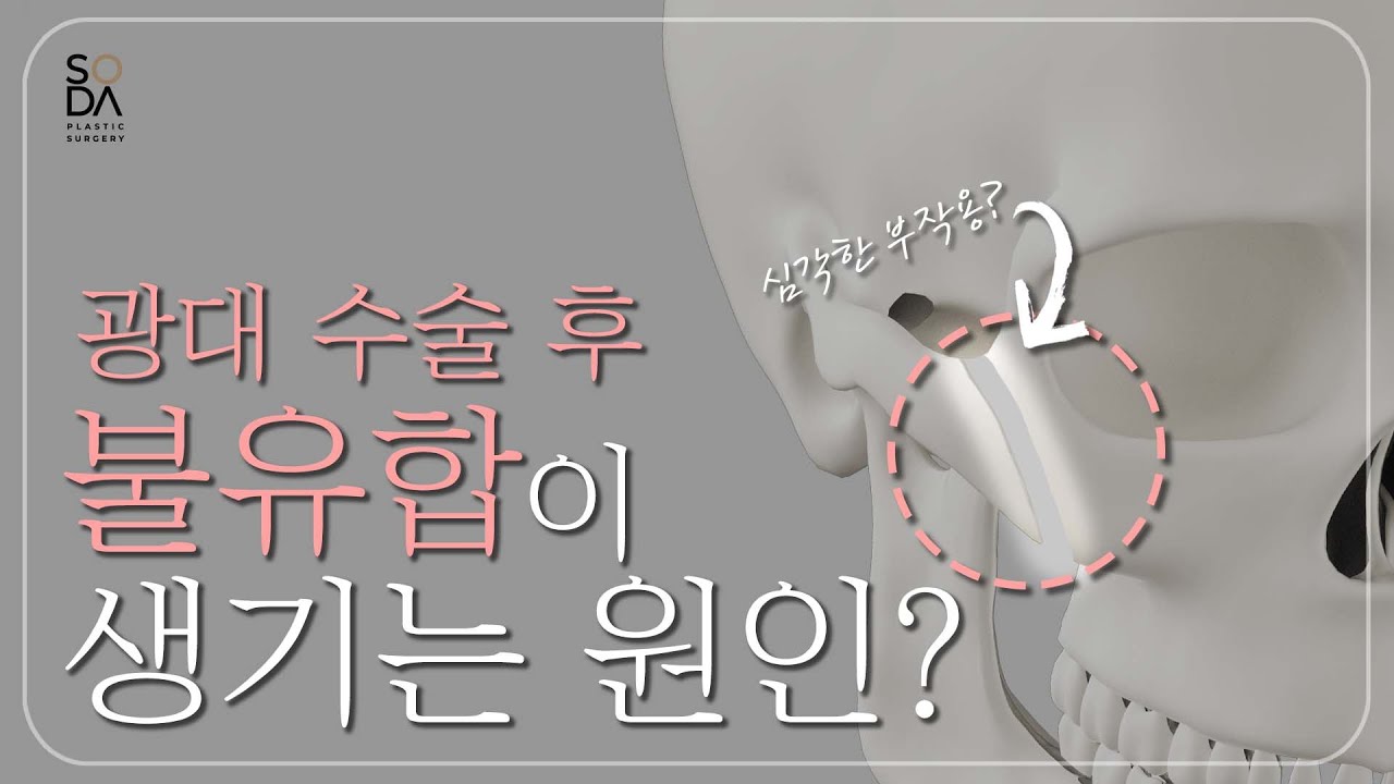 [SODA] 소다성형외과 | 광대의 모든것 불유합이란?