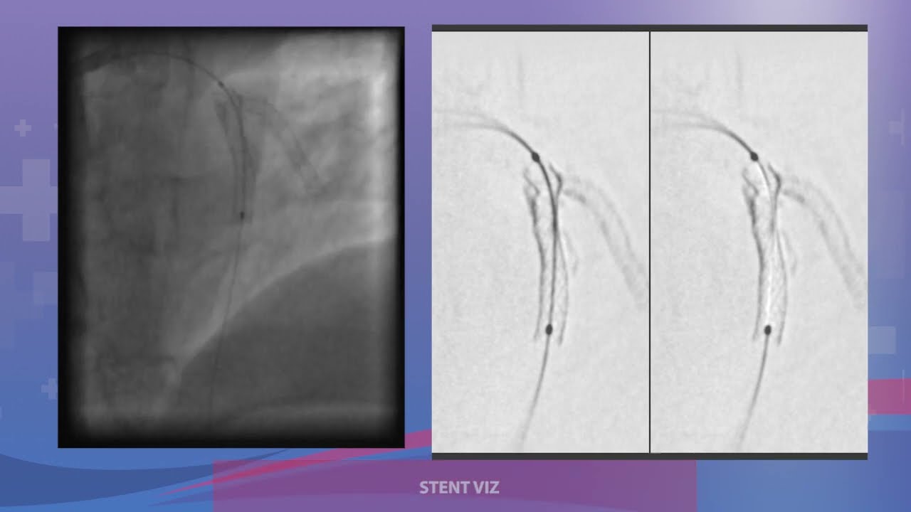 ANGIOPLASTIA COMPLEJA OCLUSION TOTAL DE RAMO DIAGONAL
