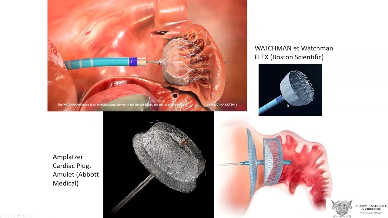Fermeture de l'auricule gauche. Indication et Faisabilité