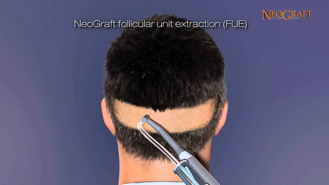 NeoGraft Animated Hair Restoration Video - See how Surgery can Restore Your Hair