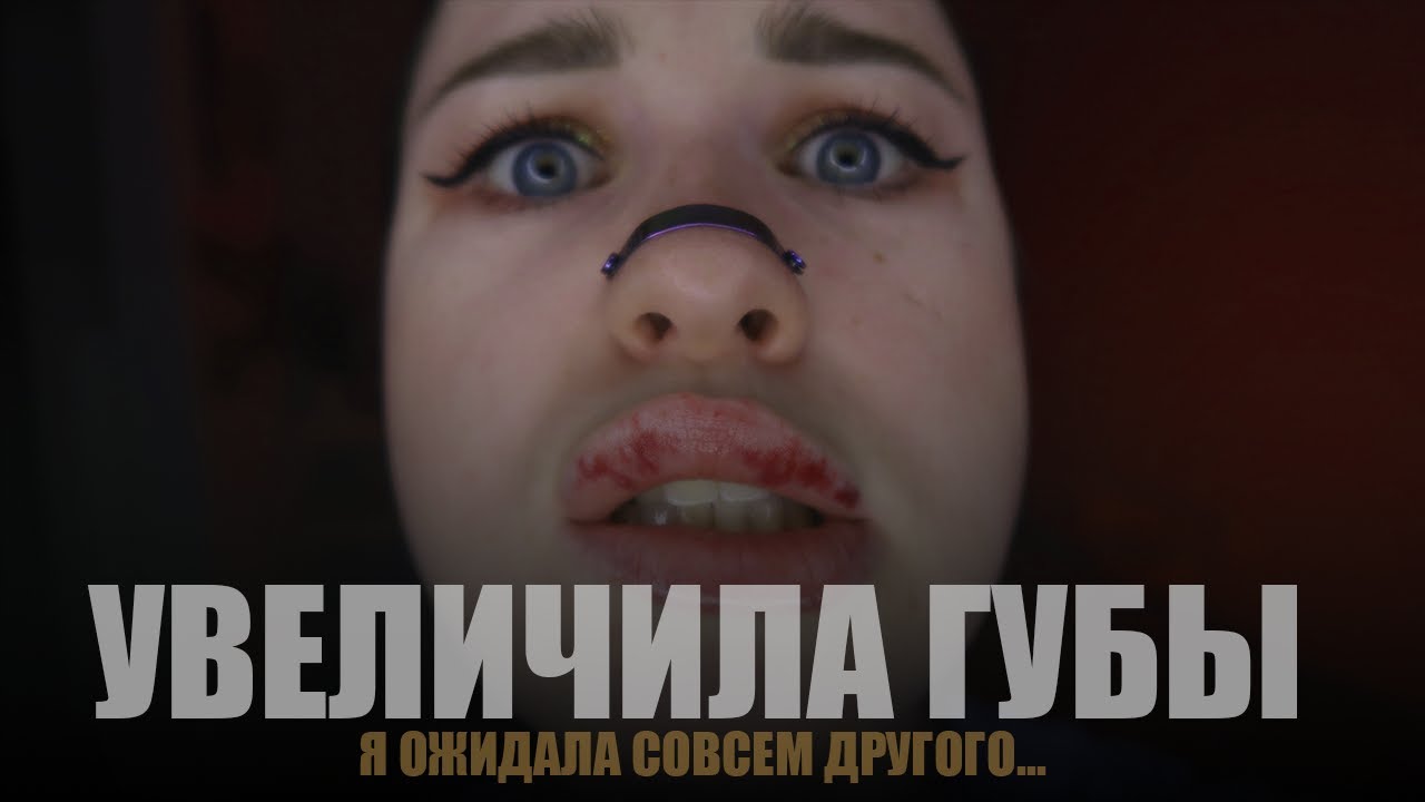 Я СДЕЛАЛА ГУБЫ.... С ДИАБЕТОМ 1 ТИПА | ВЕСЬ ПРОЦЕСС ЗАЖИВЛЕНИЯ