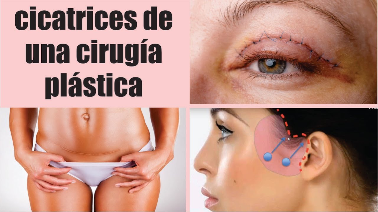 CICATRICES que deja la CIRUGÍA PLÁSTICA 😱😰🥵 Cómo abordar y tratar las cicatrices 😍 Dr. Percy Nevado
