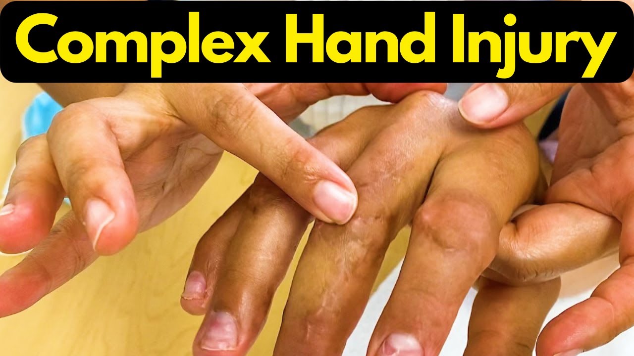 Complex Hand Injury Therapy & Overview | Multiple Finger Fractures