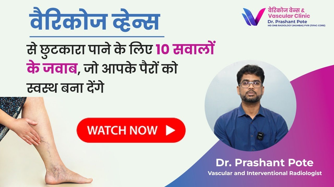 Varicose Veins Your Top 10 Questions Answered  | By Dr. Prashant Pote