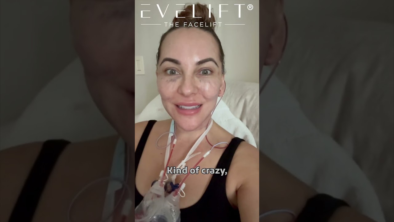 Patient Sheila's EVE Lift™ Journey Part 1 | Eden Plastic Surgery: Dr. Ali Charafeddine, MD