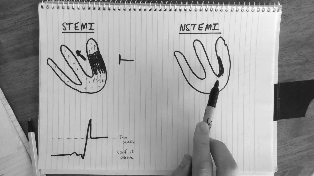 ST-segment changes in STEMI & NSTEMI explained