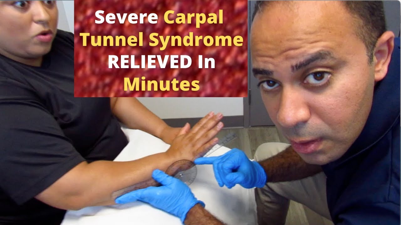 Severe * Carpal Tunnel Syndrome * RELIEVED In No Time
