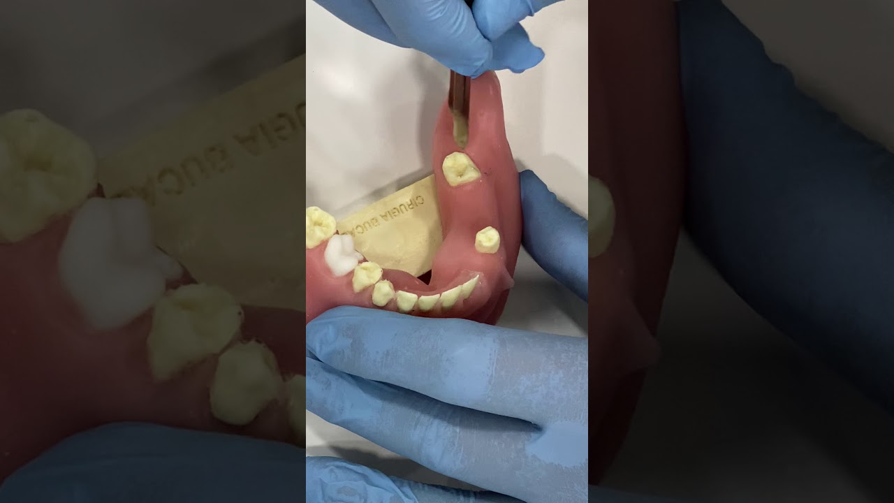 Implant placement in 36