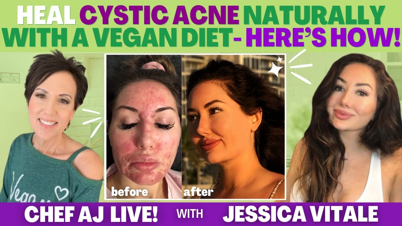Jessica Vitale Heals Cystic Acne NATURALLY with a Vegan Diet- here’s how!