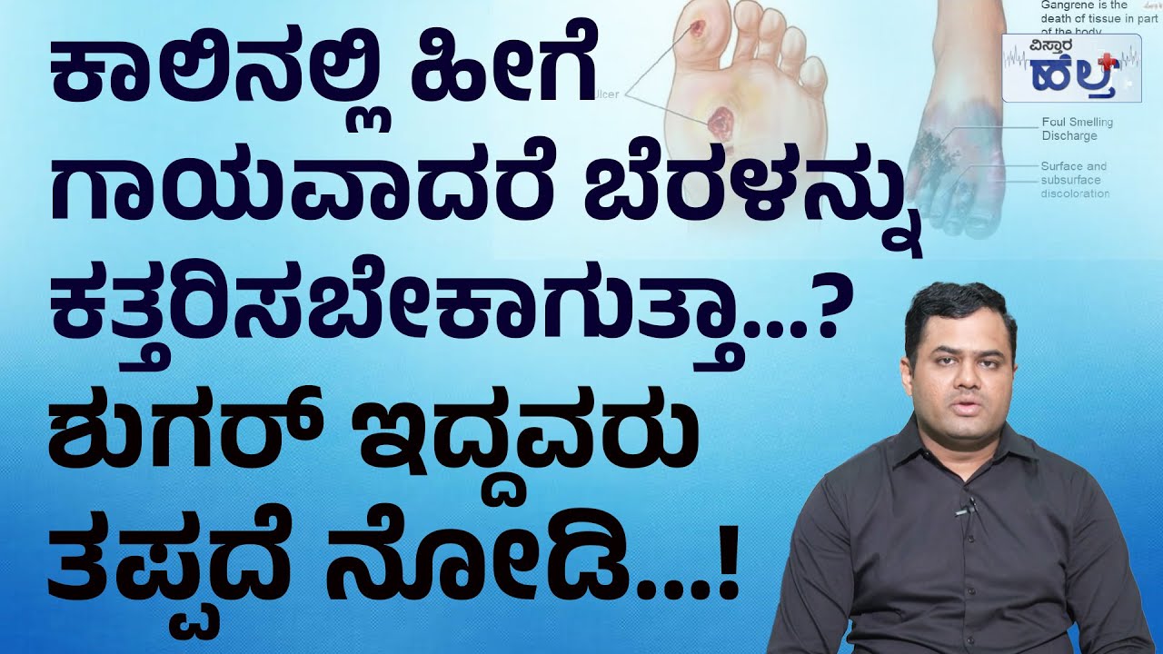 ಶುಗರ್‌ ಇದ್ದವರು ಗಾಯವಾದಾಗ ಏನು ಮಾಡಬೇಕು..? | Diabetes Foot Ulcer Treatment And Symptoms In Kannada