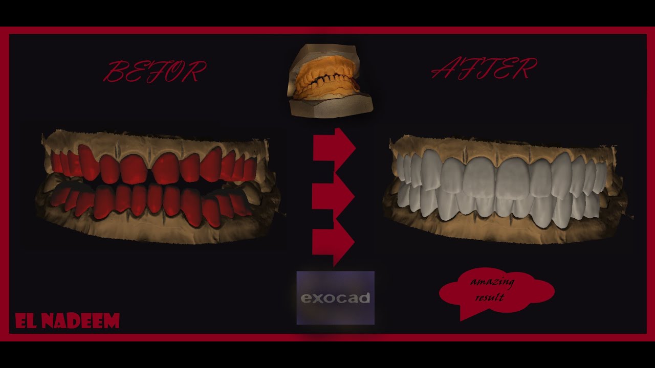 How to design amazing full mouth from A to Z with exocad software ? (Don't  miss this video)