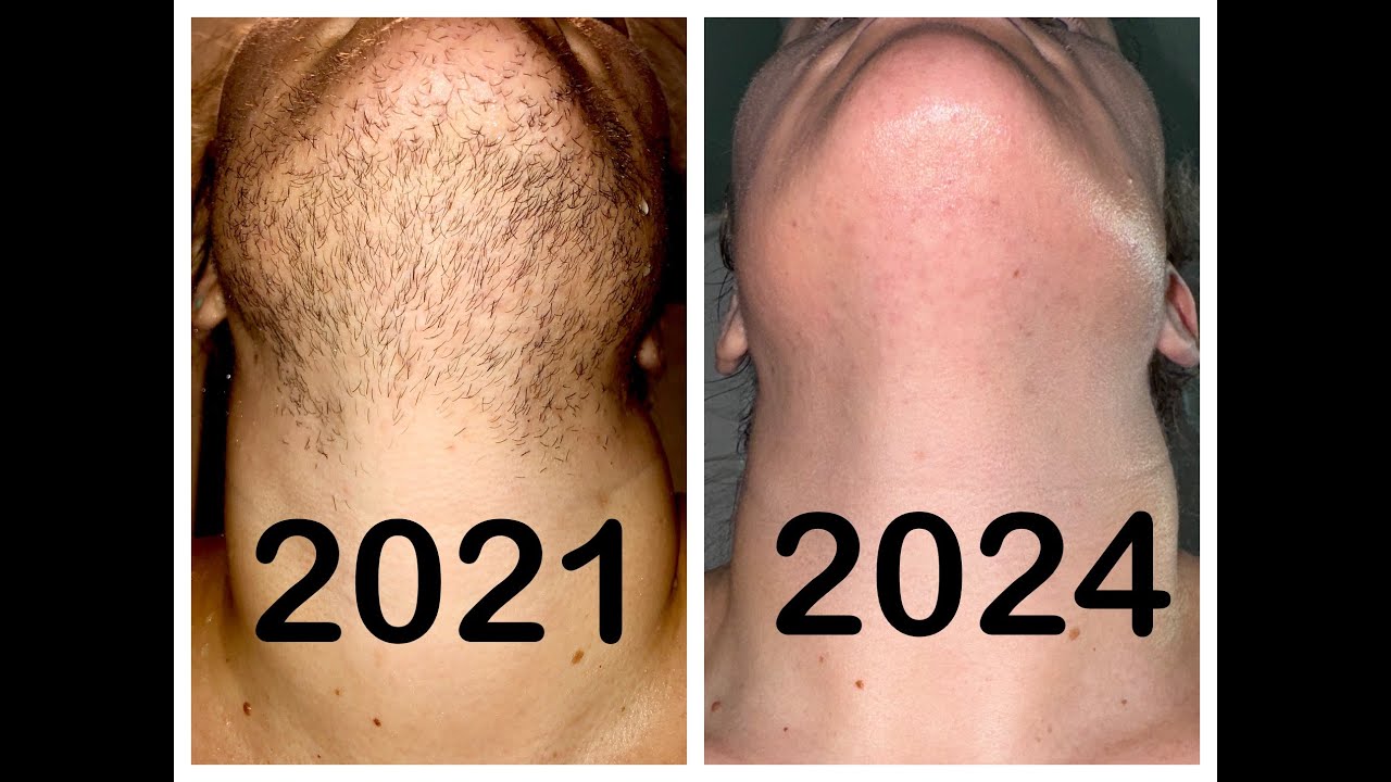 Satisfying electrolysis hair removal footage | 153 Hours of treatments | PCOS Hirsutism Progress