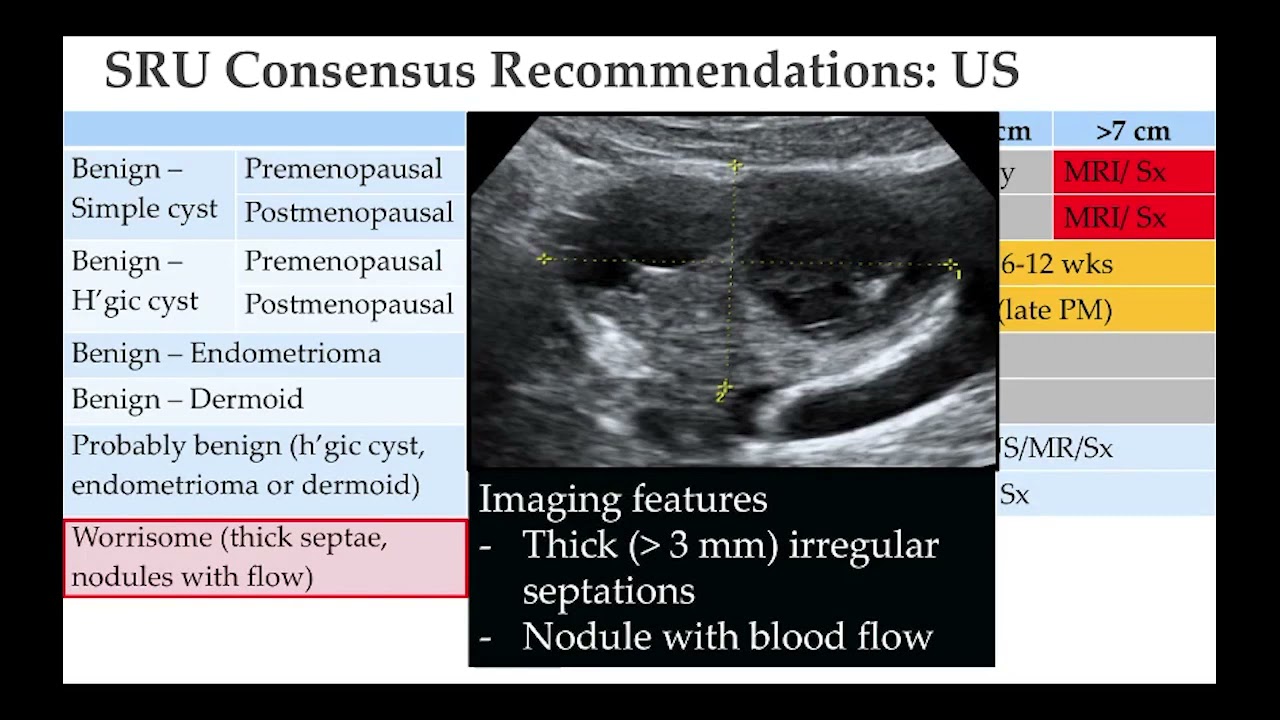 Imaging evaluation of ovarian lesion