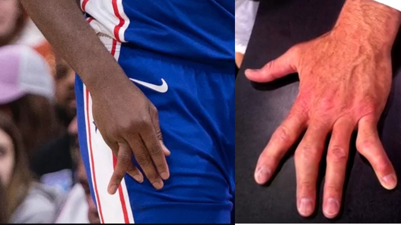 The NBA’s Most Shocking Hand  Injuries Ever